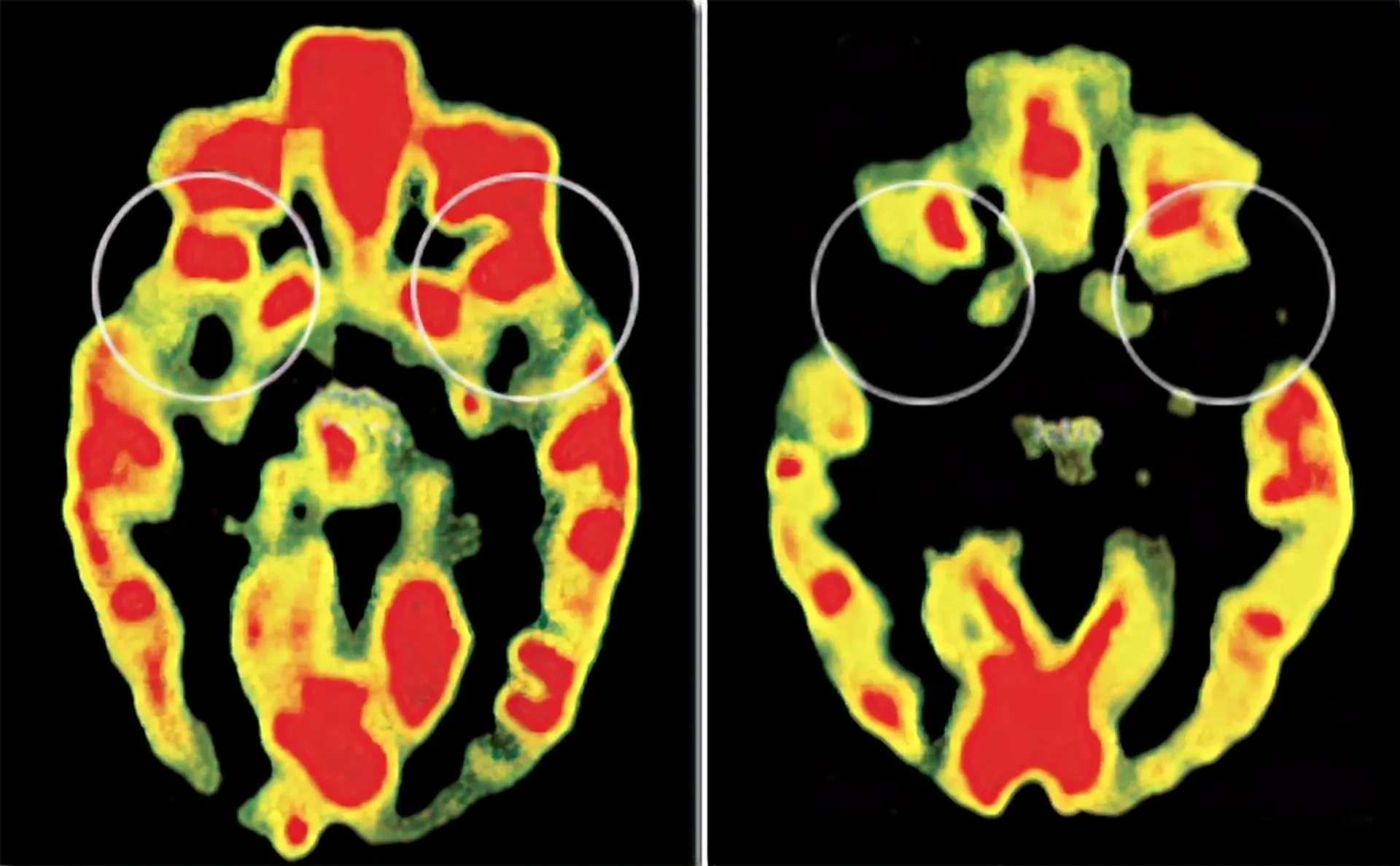Two images of brain scans. Left: healthy, emotionally developed brain. Right: Brain of abused and neglected. Dark areas show inactive or undeveloped areas.